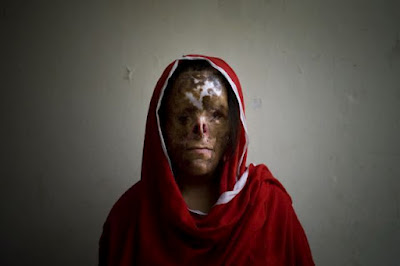 Mulheres expõem cicatrizes para denunciar violência doméstica em ensaio de fotos